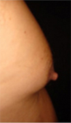 male nipple before reduction